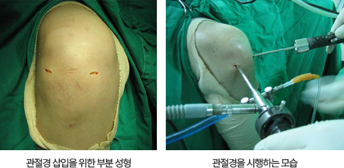 관절경 삽입을 위한 부분 성형 및 관절경을 시행하는 모습