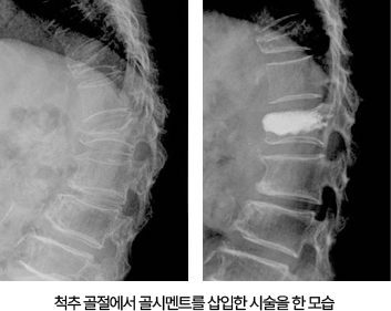 척추 골절