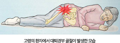 고관절 골절
