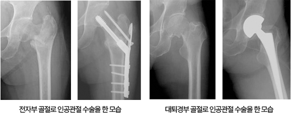 대퇴경부 골절