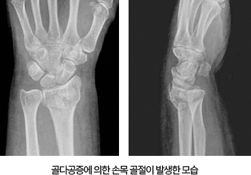 손목 골절