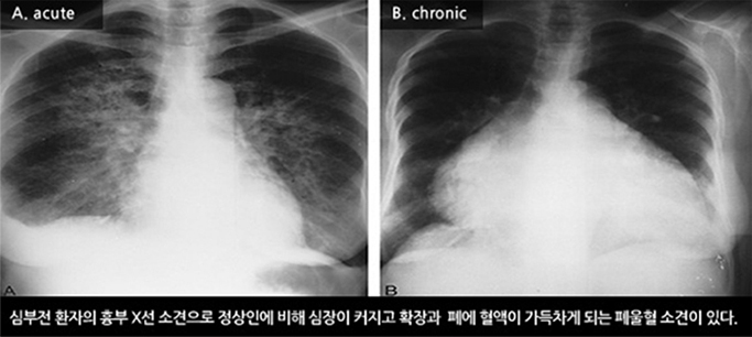 흉부 X-선 검사