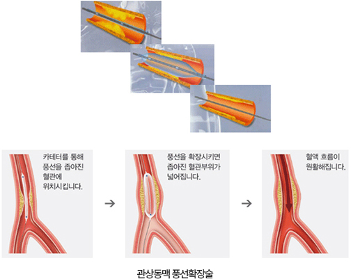 관상동맥 풍선확장술