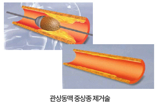 동맥경화 죽상종 제거술