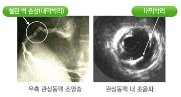 혈관내 초음파