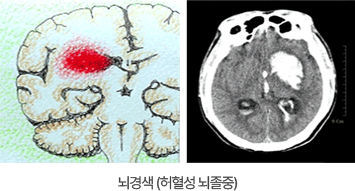 뇌경색(허혈성 뇌졸중)