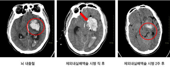 혈관이 터진 뇌출혈