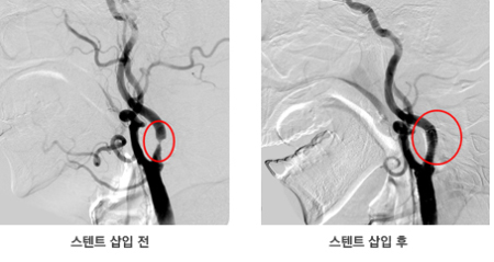 스텐트 삽입술 전과 후