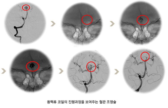 동맥류 코일의 진행과정을 보여주는 혈관 조영술