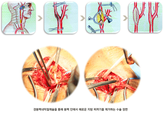 경동맥 내막절제술