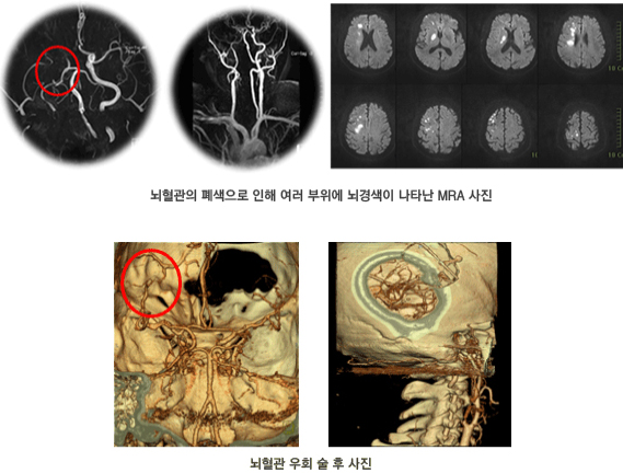뇌혈관우회술