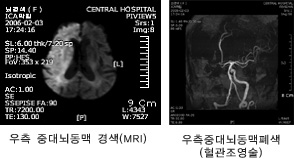 우측 중대뇌동맥 경색(MRI), 우측중대뇌동맥폐색(혈관조영술)