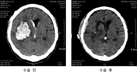 개두술 및 미세현미경적 혈종제거술 시행한 환자