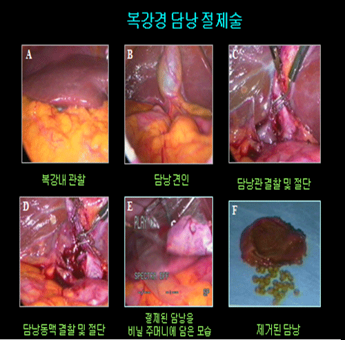 복강경 담낭 절제술