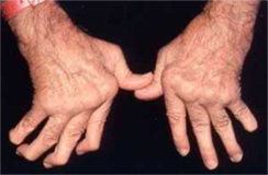 류마티스 관절염 환자의 손